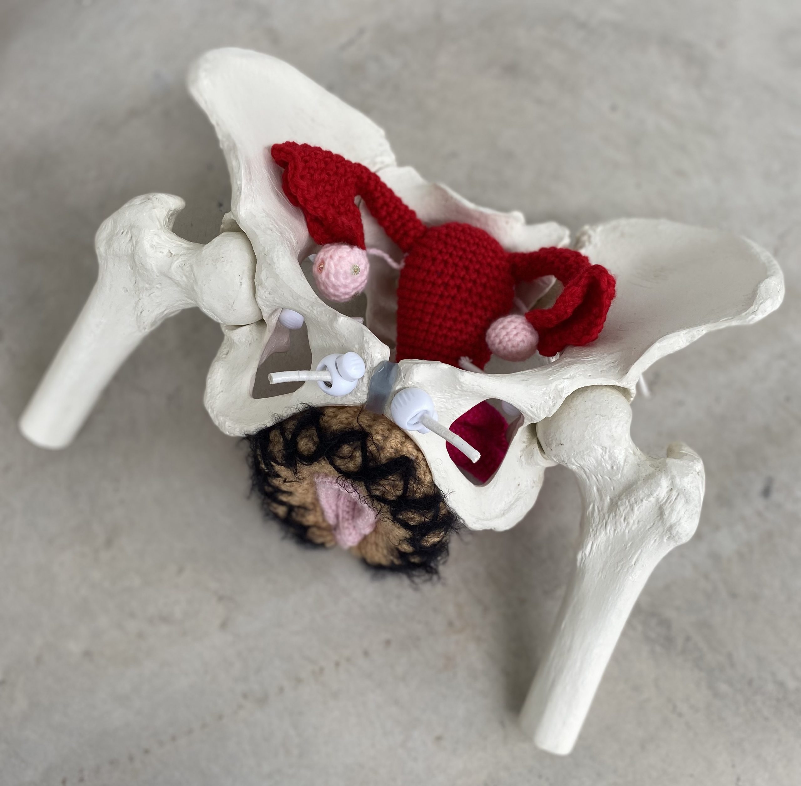 Disfunciones de suelo pélvico